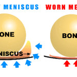 Healthy and Worn Meniscus