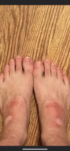 ProKnee case study 4