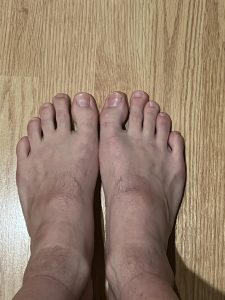 ProKnee case study 5